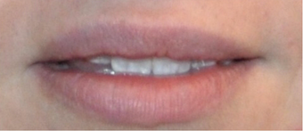 Juvederm for Lip Augmentation after 3808793