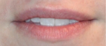Juvederm for Lip Augmentation before 3808793