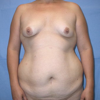 Mommy Makeover: Tummy Tuck, Liposuction Trunk, Trans-axillary Breast augmentation before 655646