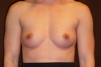 Breast Augmentation before 587757
