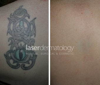 Laser tattoo removal before 1332027