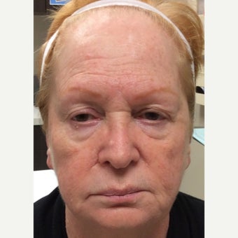 65-74 year old woman treated with ProFractional Laser before 2270332