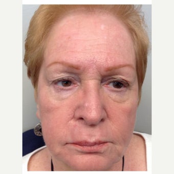 65-74 year old woman treated with ProFractional Laser after 2270332