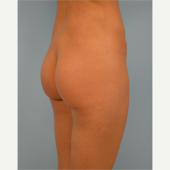 31 year old woman treated with Brazilian Butt Lift after 3432354