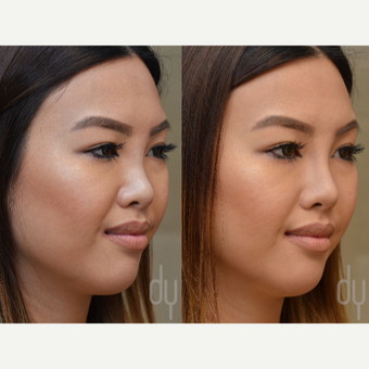 Non Surgical Rhinoplasty before 3322520