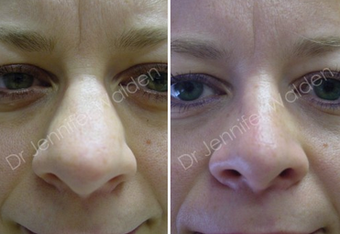Septorhinoplasty before 1112655