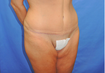 45-54 year old woman treated with Tummy Tuck 2459794