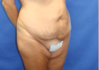 45-54 year old woman treated with Tummy Tuck 2459794