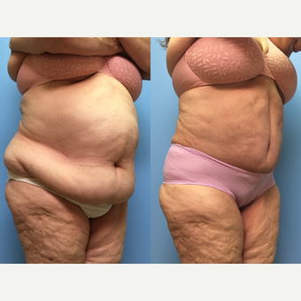66 year old woman treated with Tummy Tuck and Lipo 360 before 3224659