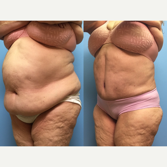 66 year old woman treated with Tummy Tuck and Lipo 360 after 3224659