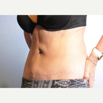 55-64 year old woman treated with ThermiTight after 2337485