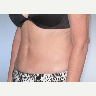 55-64 year old woman treated with ThermiTight before 2337485