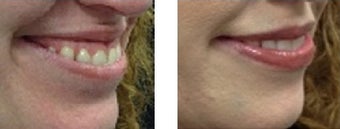 Gummy Smile Correction before 770858