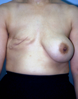 Breast Reconstruction before 1357606