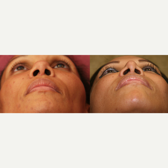 African American Rhinoplasty before 3424002