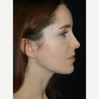 Fat Transfer after 1637882