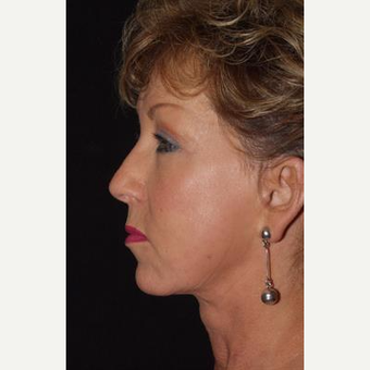 55-64 year old woman treated with Facelift after 3481297