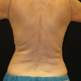 65-74 year old woman treated with CoolSculpting before 3575513