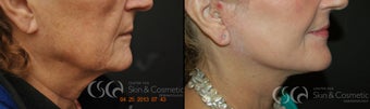 Safelift with Co2 resurfacing before 1090011