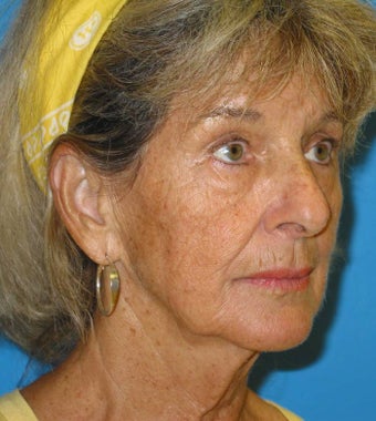 74 Year old woman treated for loss of facial volume with Sculptra before 1007719