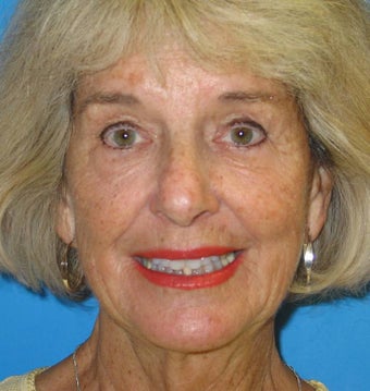 74 Year old woman treated for loss of facial volume with Sculptra 1007719