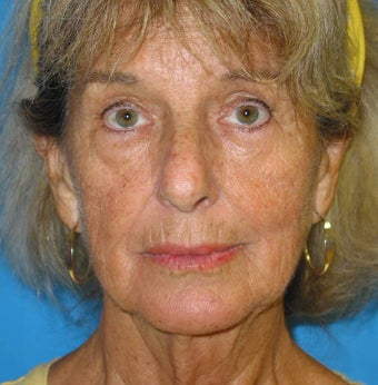 74 Year old woman treated for loss of facial volume with Sculptra 1007719