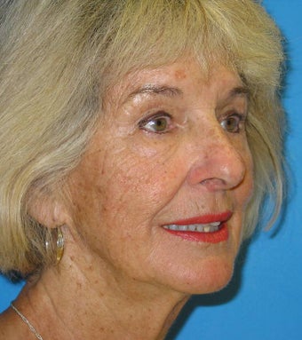 74 Year old woman treated for loss of facial volume with Sculptra after 1007719