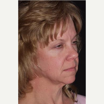 52 year old seeking more youthful appearance before 3481144