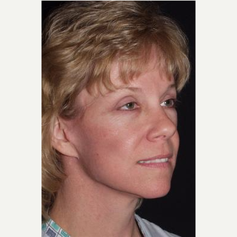52 year old seeking more youthful appearance after 3481144