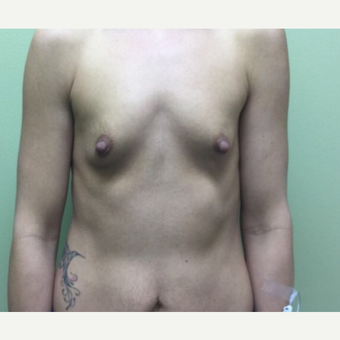 25-34 year old woman treated with Breast Augmentation before 3012194