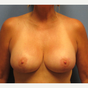 45-54 year old woman treated with Breast Implants after 3174700