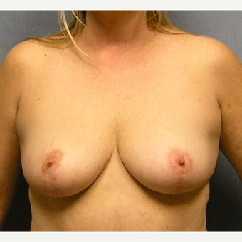 45-54 year old woman treated with Breast Implants before 3174700