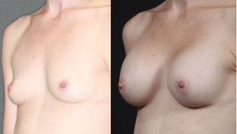 Mother, early 30s, breast augmentation with round 250cc after 1050492