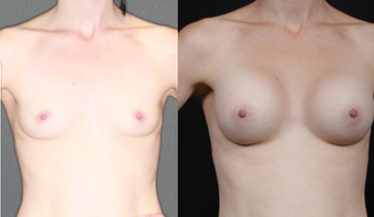 Mother, early 30s, breast augmentation with round 250cc before 1050492