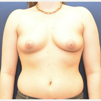 25-34 year old woman treated with Breast Augmentation before 3726843