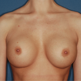 25-34 year old woman treated with Breast Augmentation after 3371675