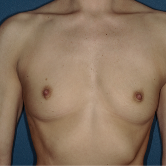 25-34 year old woman treated with Breast Augmentation before 3371675