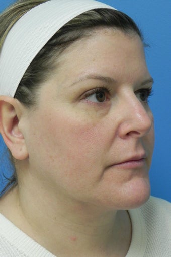45 Year Old Female ~ Neck Lift after 1350480