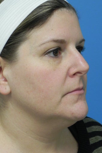 45 Year Old Female ~ Neck Lift before 1350480