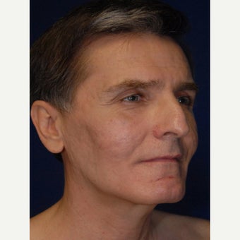 35-44 year old man treated with Bellafill after 2450414