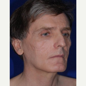 35-44 year old man treated with Bellafill before 2450414