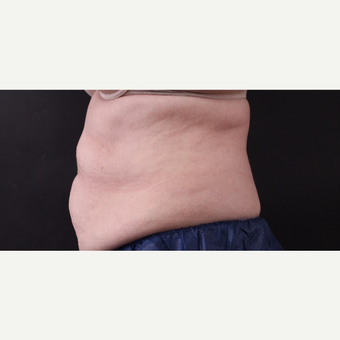 62 year old woman treated with CoolSculpting before 3221063