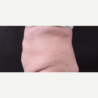 62 year old woman treated with CoolSculpting after 3221063