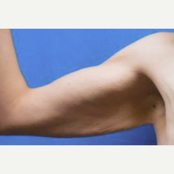 25-34 year old woman treated with Arm Lift before 3549195