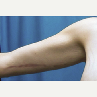 25-34 year old woman treated with Arm Lift after 3549195