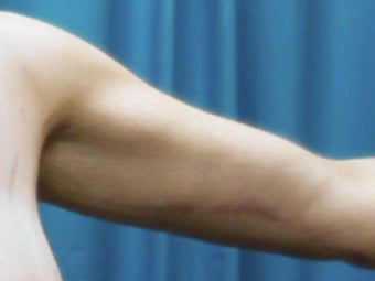 25-34 year old woman treated with Arm Lift 3549195