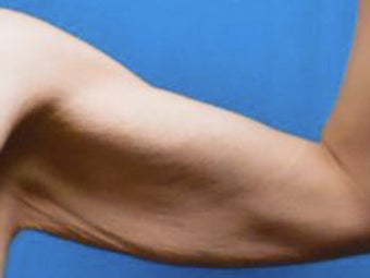 25-34 year old woman treated with Arm Lift 3549195