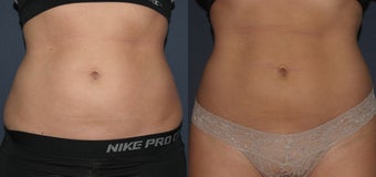 CoolSculpting Before and After Photo before 1033823