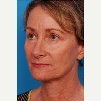 55-64 year old woman treated with Brow Lift after 2995450