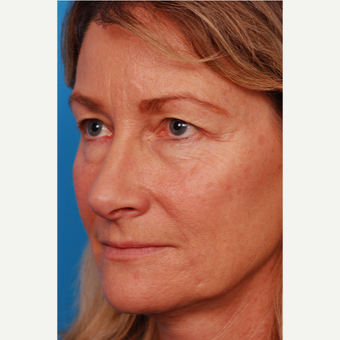 55-64 year old woman treated with Brow Lift before 2995450